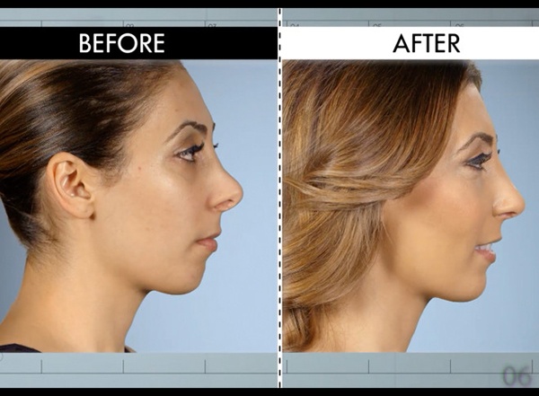 Bệnh nhân Diana than phiền về chiếc mũi mới sau khi chỉnh sửa của cô khá giống với mũi lợn. Bác sĩ của Botched đã sửa lại phần bị hếch cũng như thu gọn hốc mũi.