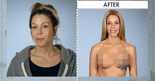 Sống sót sau trận chiến với ung thư vú nhưng vòng 1 của nữ bệnh nhân Cynthia không hề đẹp mắt, cô được Botched phục hồi lại đôi gò bồng đảo trở nên tự nhiên hơn.