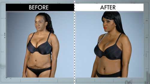 Sau cuộc phẫu thuật tạo hình thành bụng bằng việc hút mỡ, cắt bỏ da và phần bụng dưới, khâu nhỏ lại cân cơ bụng nhưng để lại nếp nhăn và đường khâu xấu xí, bệnh nhân Desiree tưởng như không thể mặc bikini được nữa. Nhưng bức ảnh bên phải là kết quả sau khi cô được Botched “hô biến” lại vòng 2.