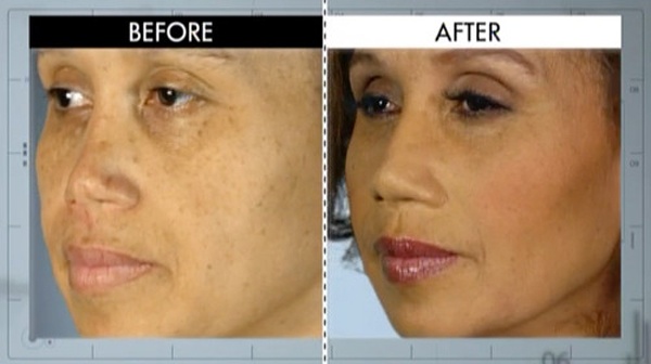 Người phụ nữ Michelle không may gặp một tai nạn xe hơi khủng khiếp cách đây nhiều năm, hậu quả là cô phải 6 lần đi làm lại mũi nhưng Michelle vẫn chưa hài lòng cho tới khi cô được các bác sĩ của Botched chỉnh sửa.