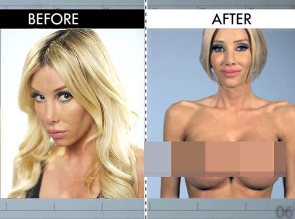 Ở tuổi 23, sao khiêu dâm chuyển giới Kimber James đã có 24 ca phẫu thuật lớn nhỏ khác nhau như bơm môi, 5 lần nâng ngực, nâng trán, tái tạo cằm, làm âm đạo… nhưng trông cô vẫn thiếu sự tự nhiên của người phụ nữ, đặc biệt bộ ngực bị mất cân đối. Qua tay 2 bác sĩ Terry Dubrow và Paul Nassif, Kimber, các bộ phận bị phẫu thuậ hỏng của Kimber như mũi, ngực và âm đạo được cải thiện trông thấy.