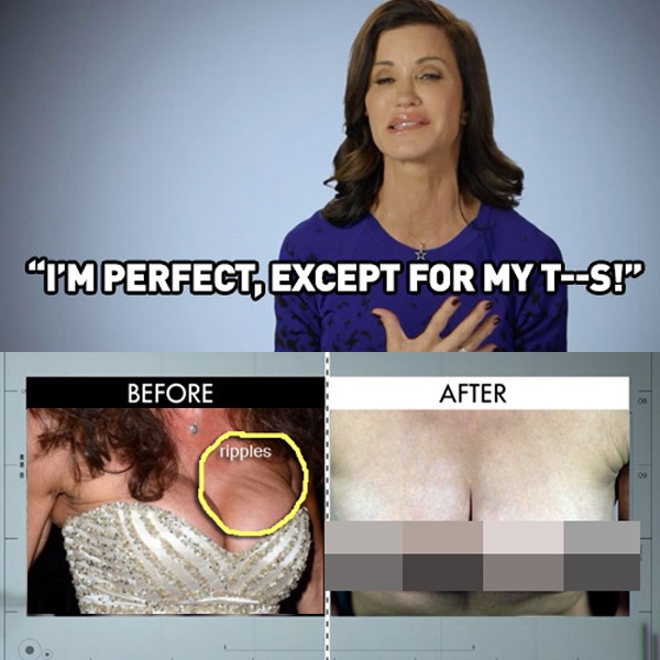 Cựu người mẫu Janice Dickinson từng cấy nâng ngực từ khi còn rất trẻ. 30 năm sau, vòng 1 của Janice trở nên thảm họa với những vết lồi lõm, lợn cợn. Sau khi trở về từ Botched, Janice hạnh phúc vì lại có thể ngắm nghía cơ thể cô.