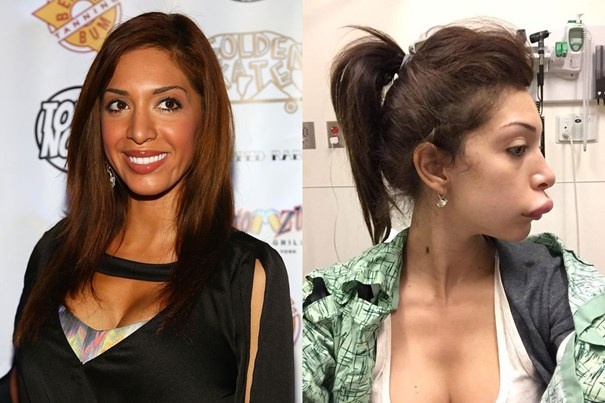 Nữ diễn viên truyền hình thực tế kiêm phim người lớn Farrah Abraham gây sốc cho khán giả đầu năm khi công bố bức ảnh đôi môi mới của cô sau khi được tu sửa. Đôi môi của Farrah bị sưng phồng khá lớn trông như mỏ vịt, gây mất cân đối với gương mặt. 