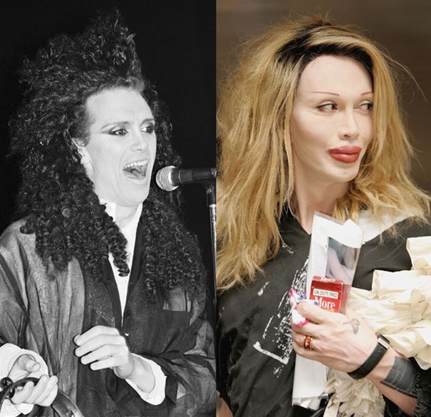 Nam ca sĩ Pete Burns là một trong những thảm họa của phẫu thuật thẩm mỹ mà dễ nhận thấy nhất là đôi môi quá cỡ của anh.  Dù thất bại nhưng Pete từng khẳng định vẫn sẽ theo đuổi dao kéo.