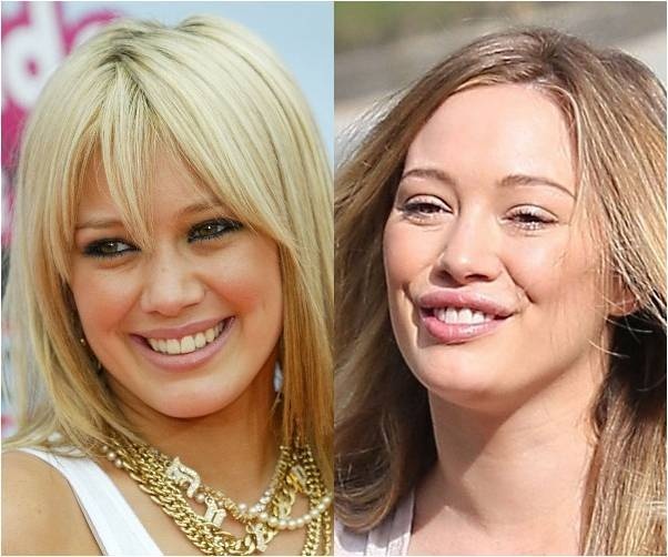 Đôi môi sau khi dao kéo của Hilary Duff tròn đầy hơn nhưng cũng kém tự nhiên. 