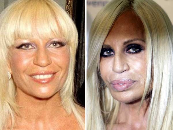 Nhà thiết kế người Ý Donnatella Versace thường xuyên có mặt trong danh sách những sản phẩm dao kéo hỏng, trong đó có làn môi dày quá cỡ của cô. 