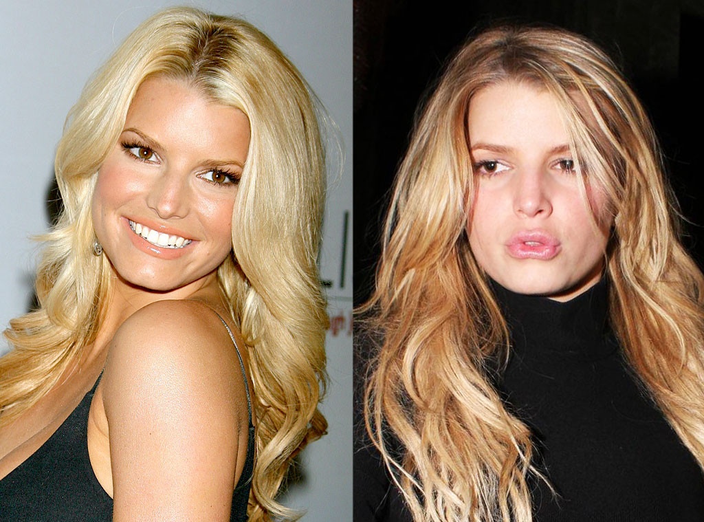 Khuôn miệng rộng của “công chúa nhạc pop tóc vàng” Jessica Simpson kém tự nhiên và rạng rỡ là hậu quả của việc tiêm chất làm đầy môi.