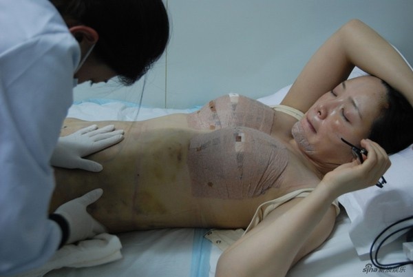 Những hình ảnh trong ca phẫu thuật thẩm mỹ nâng ngực của diễn viên Vu Tiệp khiến đông đảo cư dân mạng cảm thấy sốc. Sau ca mổ, cô đã mê man và vài tiếng sau mới tỉnh dậy. 