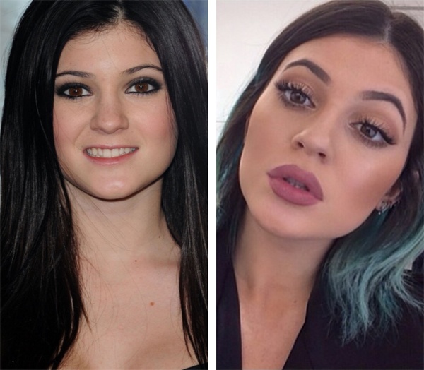 Đôi môi của Kylie dày hơn rất nhiều so với trước kia.