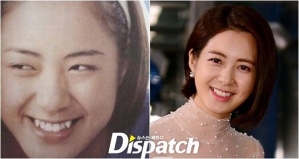 “Nữ hoàng Seon Deok” Lee Yo Won chấp nhận đánh đổi 2 chiếc răng khểnh làm duyên để hoàn thiện nụ cười.