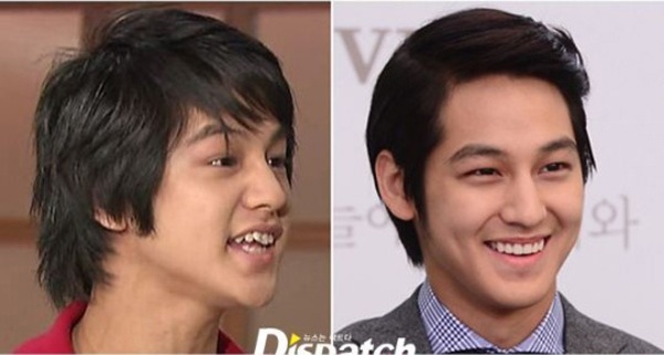 Sở hữu khuôn mặt điển trai hoàn hảo nhưng Kim Bum lại có hàm răng gập ghềnh thiếu trật tự. Mỹ nam Vườn sao băng phải nhờ cậy đến nha khoa để hoàn thiện vẻ đẹp.