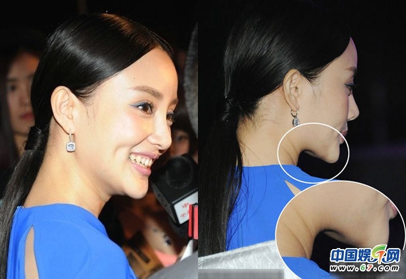 Chiếc cằm nhọn hoắt bị cho là hậu quả của việc thẩm mỹ thất bại.