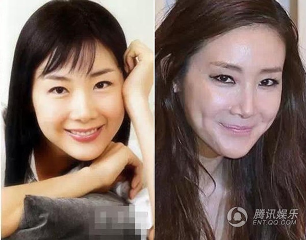 Theo thời gian, người đẹp một thời của Hàn Quốc liên tục bị nghi vấn thẩm mỹ, tiêm botox giữ nét thanh xuân.