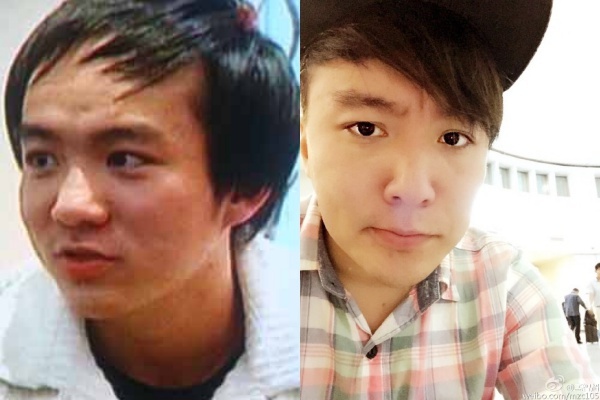 Mạnh Trí Siêu mắc bệnh không thể mọc tóc, mặt nổi đầy mụn (ảnh trái). Anh phải phẫu thuật cấy thêm tóc và dưỡng da ngày đêm với hy vọng sớm trở lại showbiz.