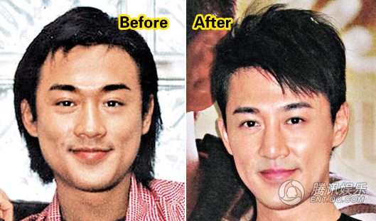 Vài năm nay, Lâm Phong liên tục vướng tin đồn thẩm mỹ vì gương mặt thon gọn hơn trước. Nhiều trang truyền thông tin rằng, tài tử còn chỉnh mũi.