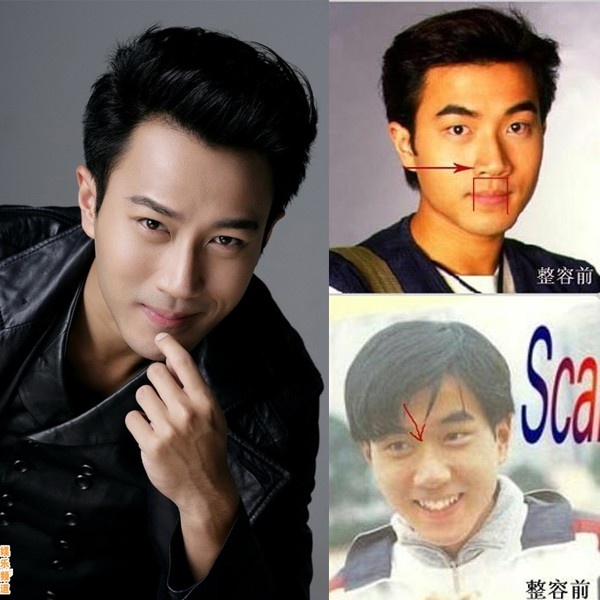 Xương quai hàm, mũi và phần cằm là minh chứng rõ rệt nhất cho việc nam diễn viên Lưu Khải Uy từng 