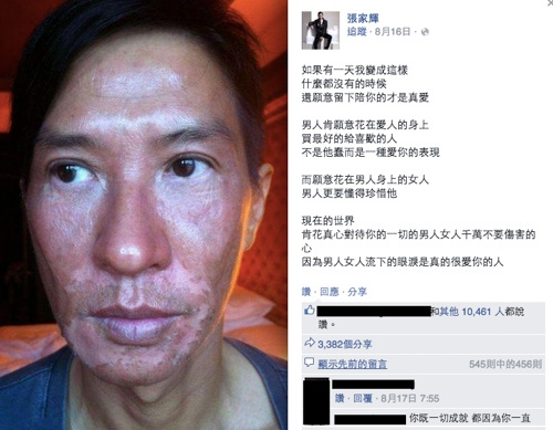 Gương mặt Trương Gia Huy bị thương tổn sau khi cháy nắng.