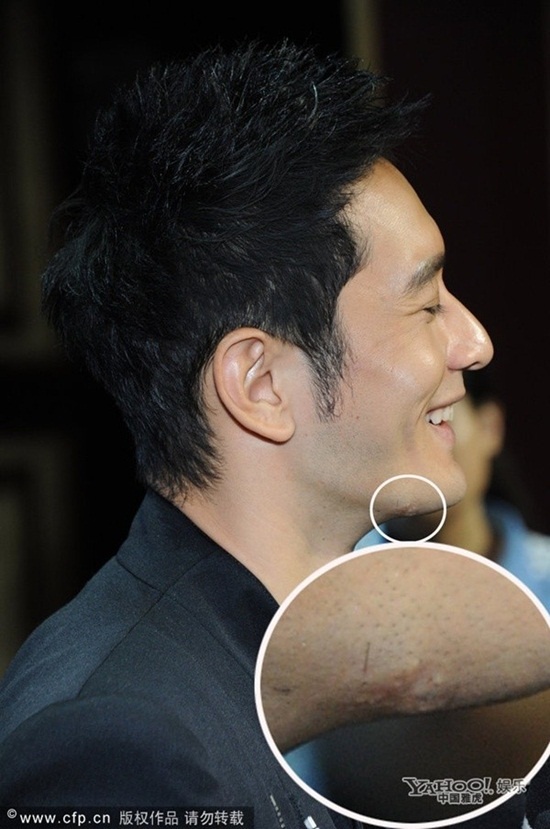 Vết sẹo khiến anh bị đặt nghi vấn độn cằm.