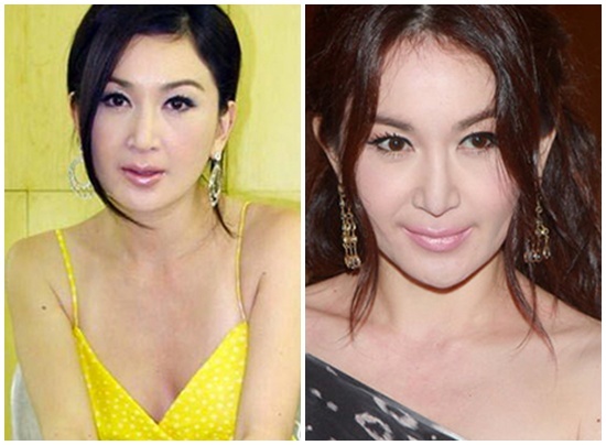 Ôn Bích Hà cũng là một trong số ít những nữ nghệ sĩ không che giấu bất cứ điều gì khi được hỏi về phẫu thuật thẩm mỹ. Cựu diễn viên 49 tuổi tiết lộ cô đã tiêm filler vào cằm và mũi. Người đẹp cũng bày tỏ quan điểm cho rằng tiêm filler đang trở nên ngày càng phổ biến và phụ nữ ai cũng có quyền theo đuổi cái đẹp.