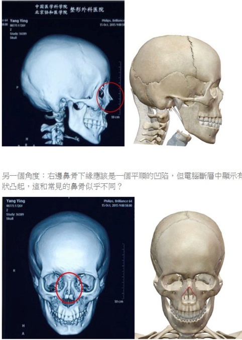Kết quả phim chụp cắt lớp của Angelababy cho thấy sống mũi cô có vật lạ, nhô hẳn (trái) trong khi người bình thường vùng mũi lõm vào và bẳng phẳng.