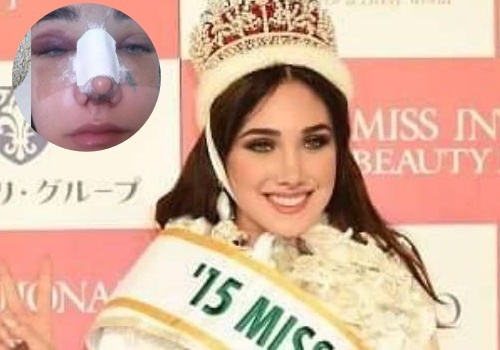 Tan Hoa hau Quoc te lo anh phau thuat tham my hinh anh