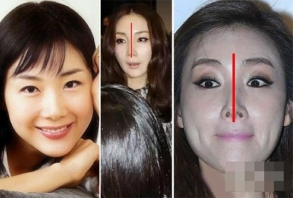 Chiếc mũi lệch sang một bên, với phần lỗ mũi biến dạng, hai bên không đều nhau chính là hậu quả của việc lạm dụng thẩm mỹ để níu kéo nhan sắc của Choi Ji Woo. Ngoài ra, người đẹp còn bị đồn tiêm botox níu giữ nét thanh xuân.