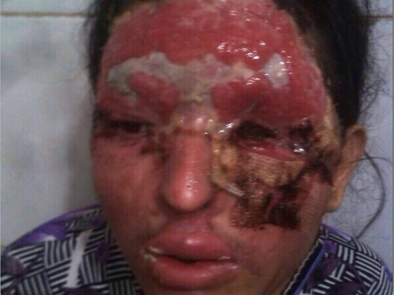 co gai An do bi tat axit anh 6