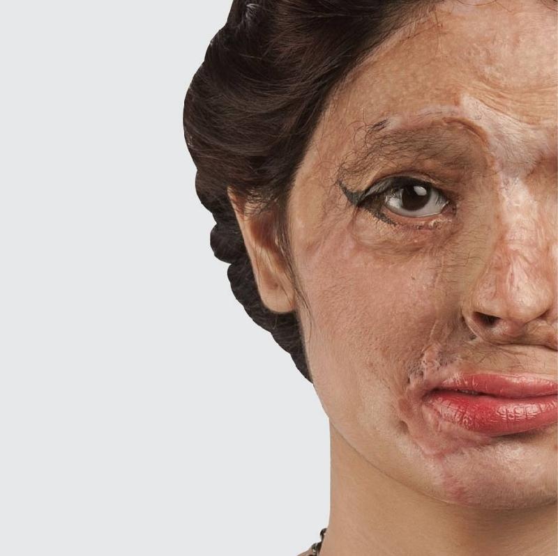 co gai An do bi tat axit anh 7