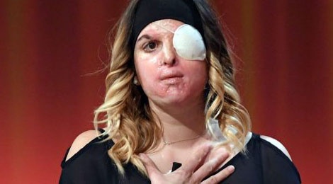 Nguoi dep Italy bi tat axit lan dau lo dien hinh anh