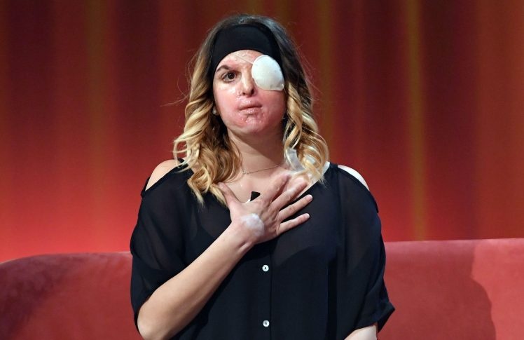 Người mẫu bị bạn trai cũ tạt axit ảnh 3 Nguoi mau bi ban trai cu tat axit anh 3