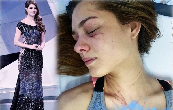 Hoa hậu Venezuela bị đánh thâm tím ảnh 1 Hoa hau Venezuela bi danh tham tim anh 1