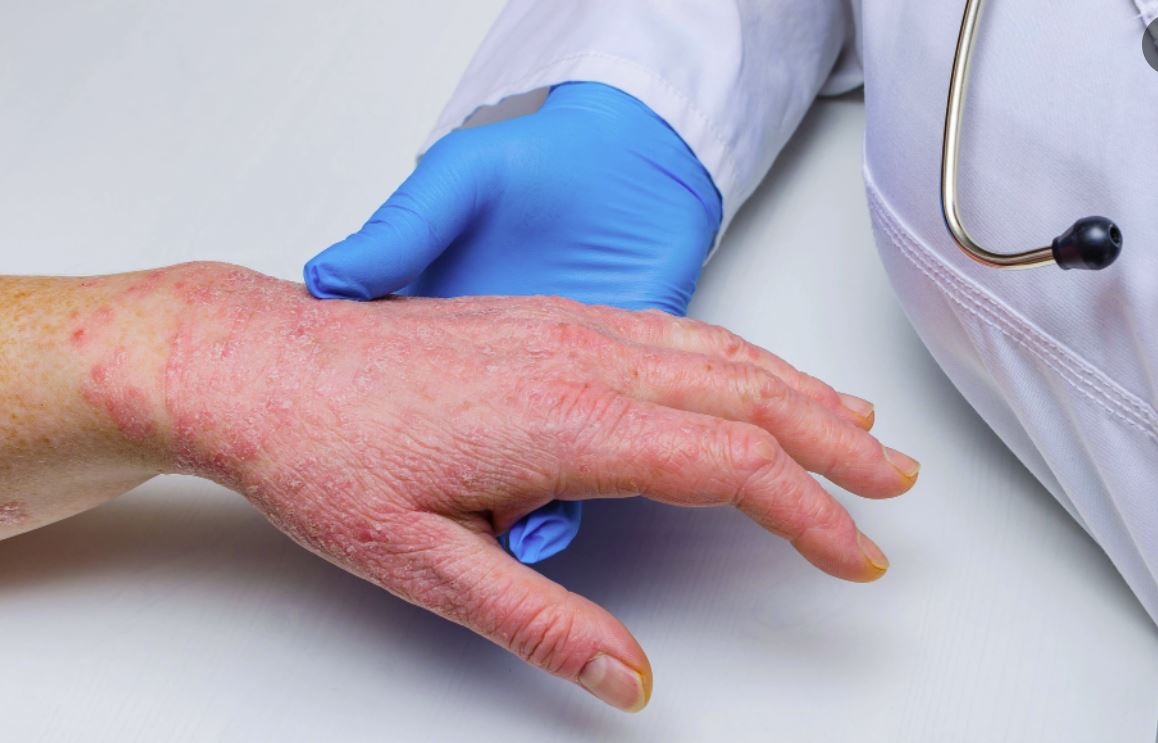 Benh dau mua khi kho phat trien thanh dai dich hinh anh