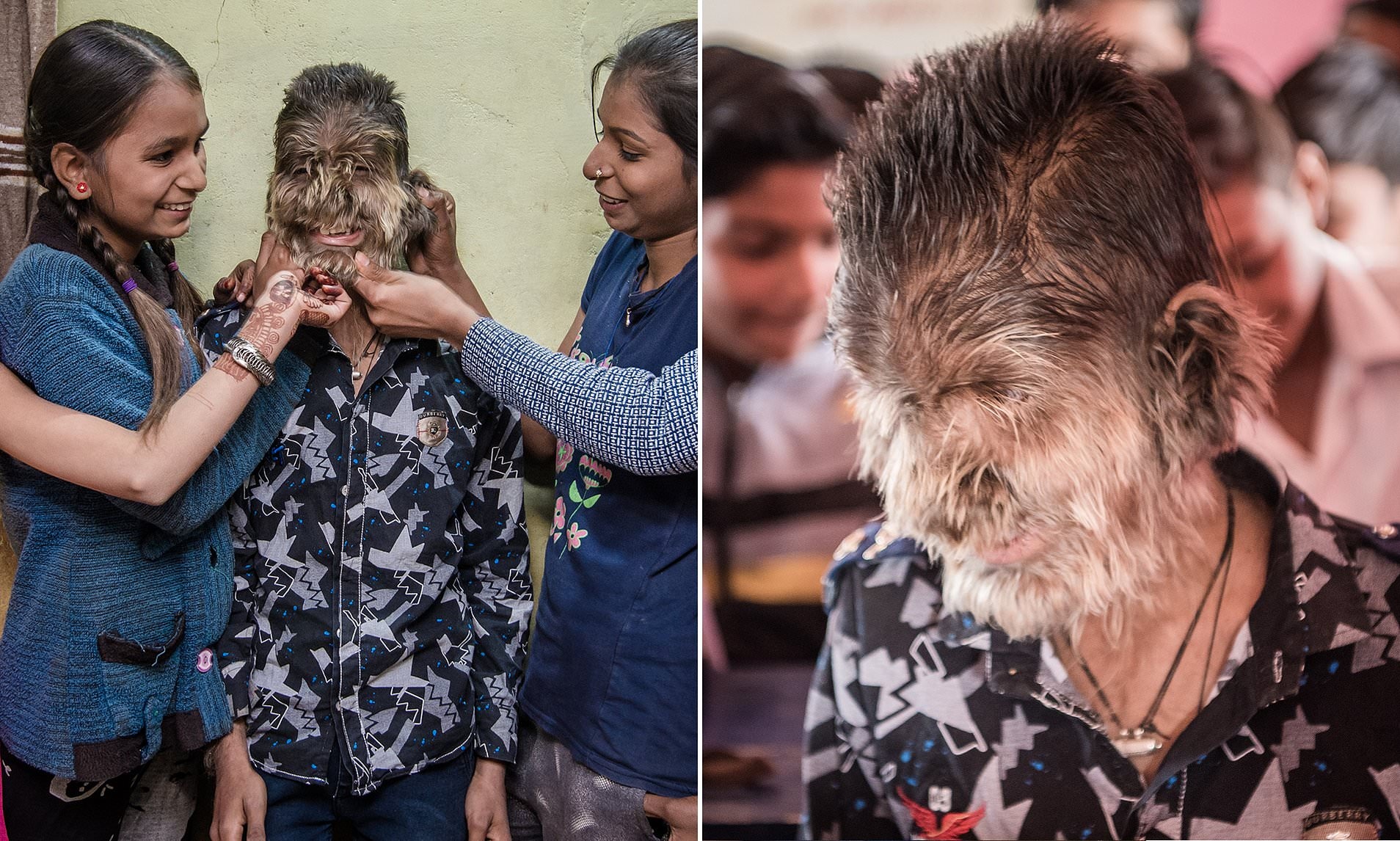 Chang trai 'nguoi soi' mac benh ky la o An Do hinh anh