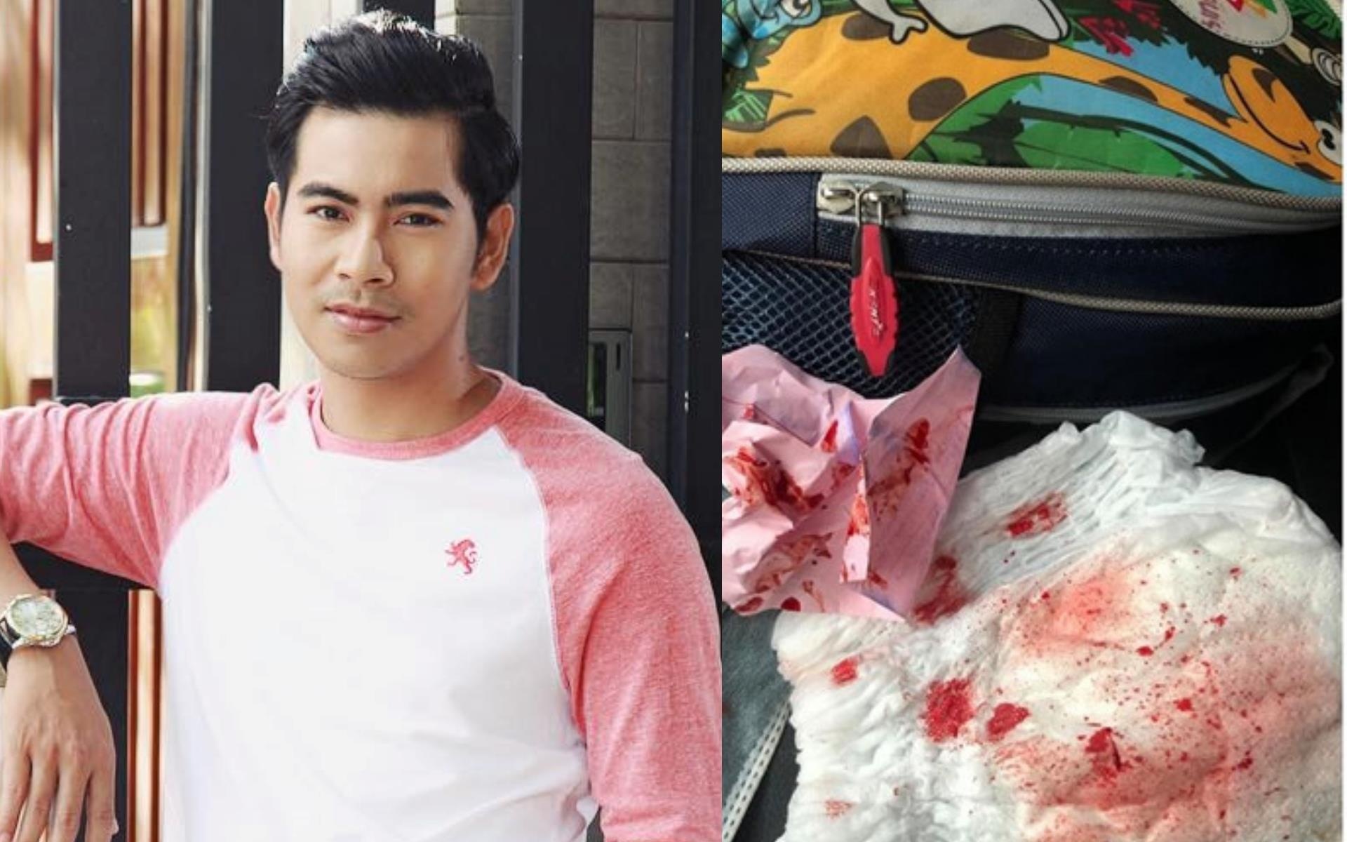 Thanh Bình chảy máu mũi ảnh 1 Thanh Binh chay mau mui anh 1