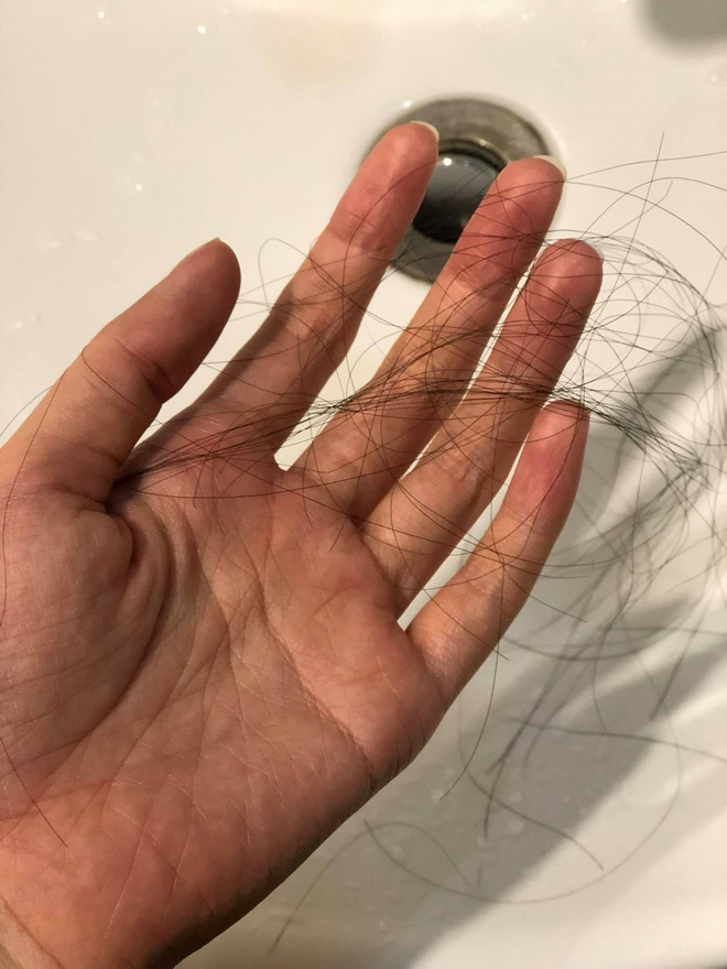 diem my bi ung thu anh 4