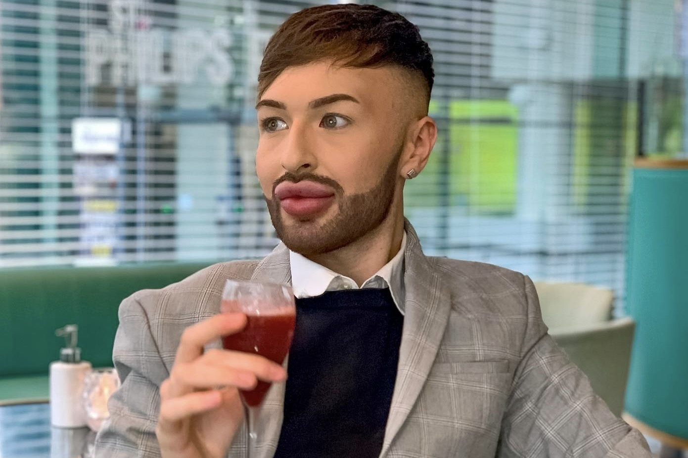 Chang trai 25 tuoi bien dang moi vi nghien tiem filler hinh anh