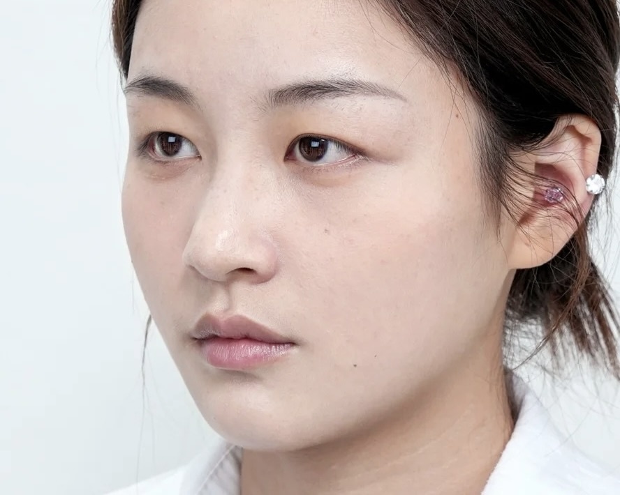 mi mat,  phau thuat,  giao dien,  dan ong,  met moi,  lam moi,  Blepharoplasty anh 1