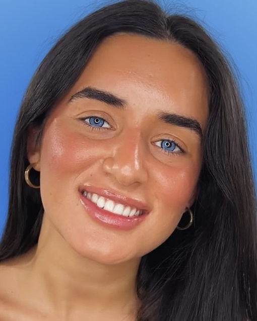 mắt,  đổi m&agrave;u,  xanh,  Keratopigmentation,  thị lực,  m&agrave;u mắt ảnh 2