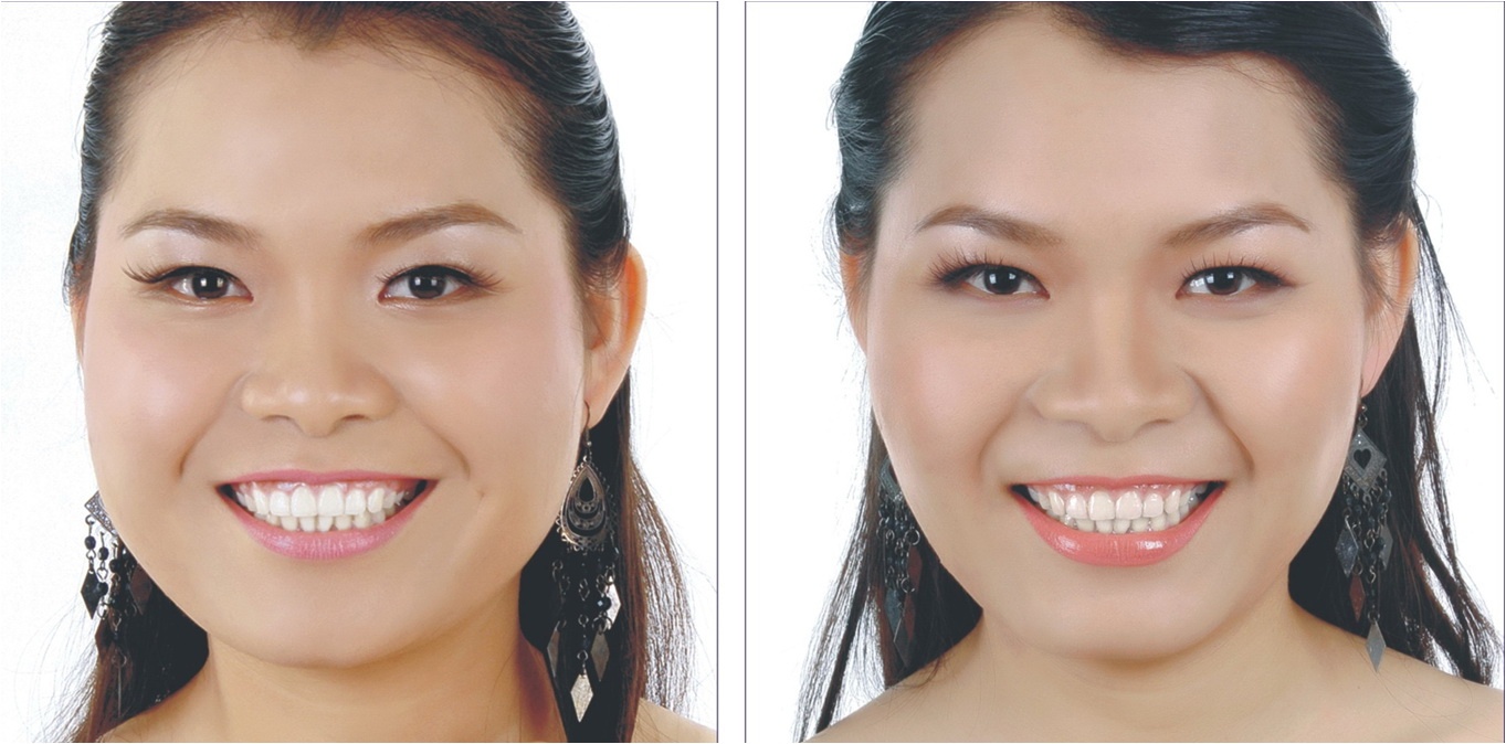 Lam dep voi botox hinh anh