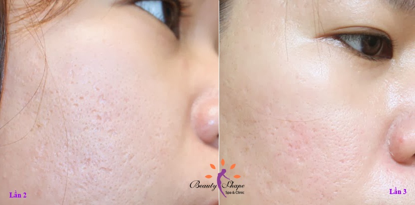Những ám ảnh do sẹo rỗ và lỗ chân lông to sẽ được xóa tan hoàn toàn nhờ Fractional CO2 Laser tác dụng 3 lần.