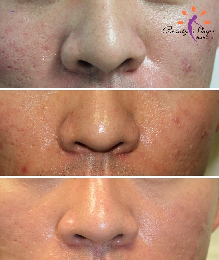 Tác động của các tia laser trong công nghệ Fractional CO2 Laser giúp làm đầy những vết sẹo rỗ, se khít lỗ chân lông và tái tạo làn da mịn màng, tươi trẻ