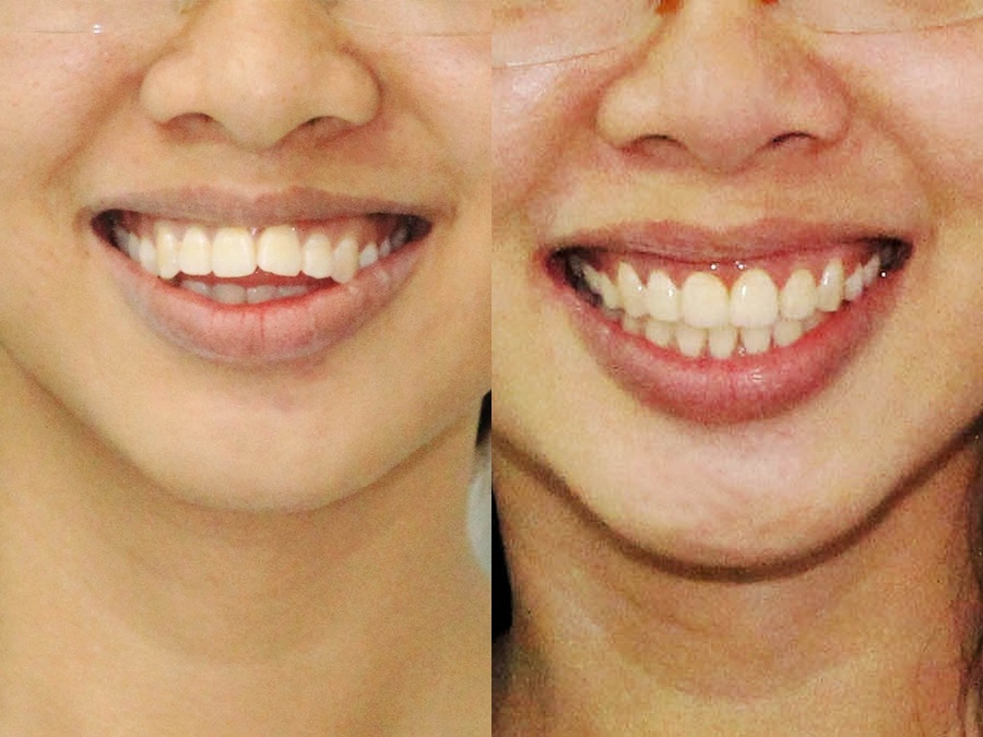 Bệnh nhân Trang trước - sau điều trị.