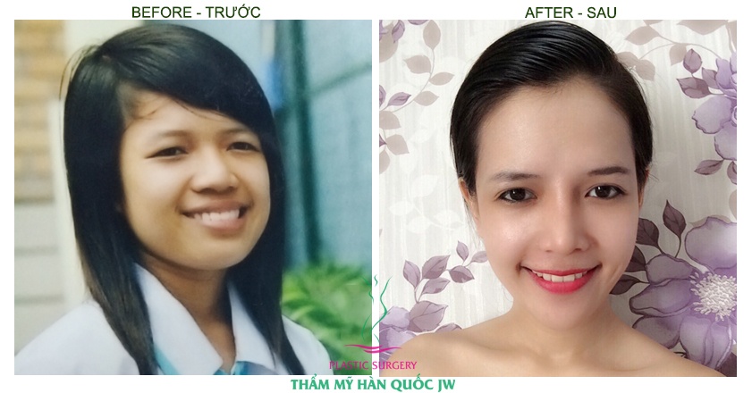 Minh Yến đã lọt xác hoàn toàn với gọt mặt v line và công nghệ thẩm mỹ toàn diện khuôn mặt tại thẩm mỹ Hàn Quốc JW.