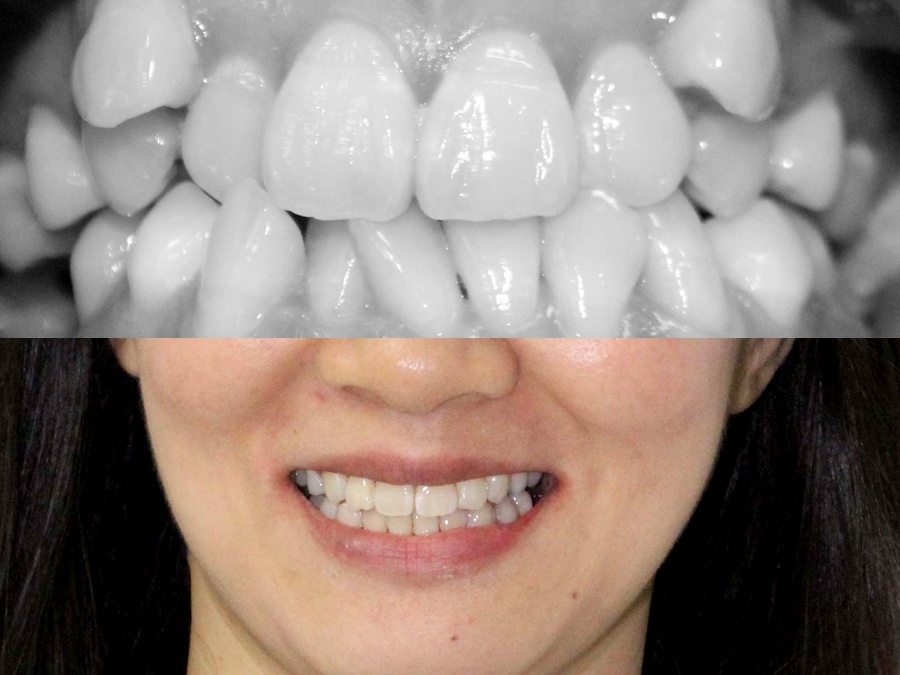Hình ảnh trước và sau điều trị của một bệnh nhân răng khểnh.