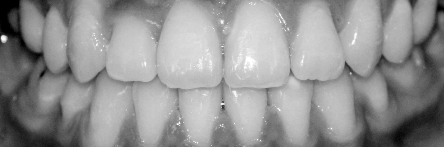 Hình ảnh trước (ảnh trên - bị móm) và sau niềng răng (khớp cắn bình thường, đẹp về thẩm mĩ).