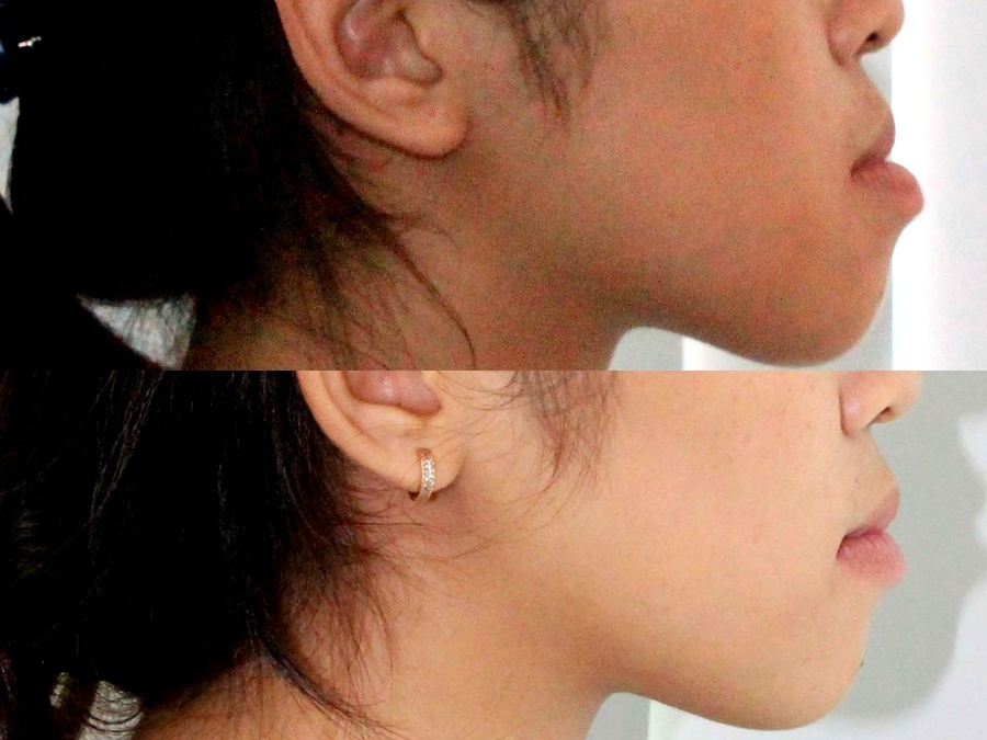 Bệnh nhân trước (ảnh trên) và sau khi được niềng răng.