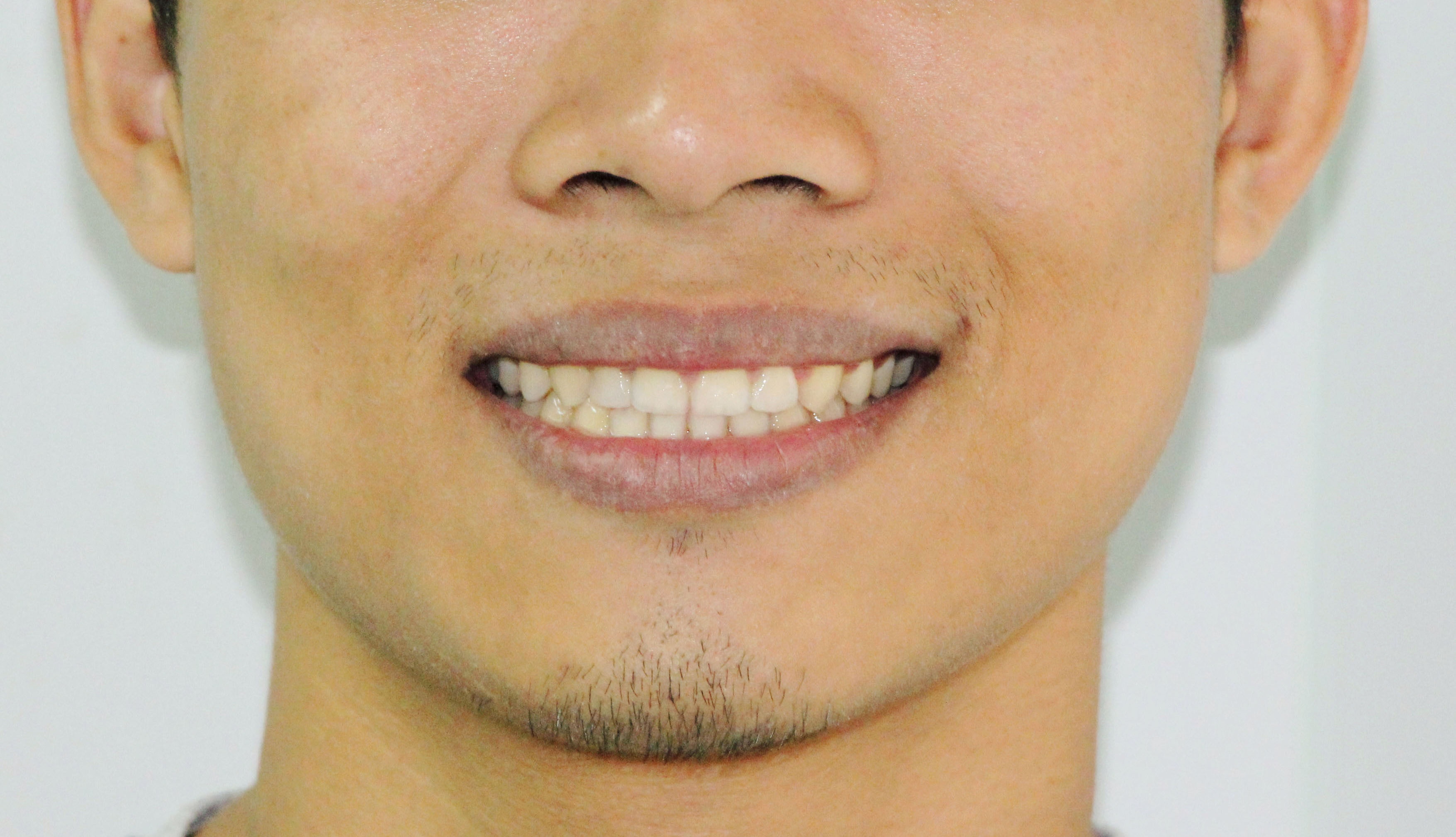 Tam biet noi lo rang thua hinh anh