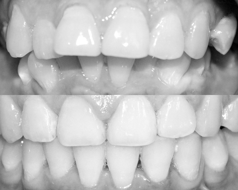 Trước (ảnh trên) và sau điều trị.