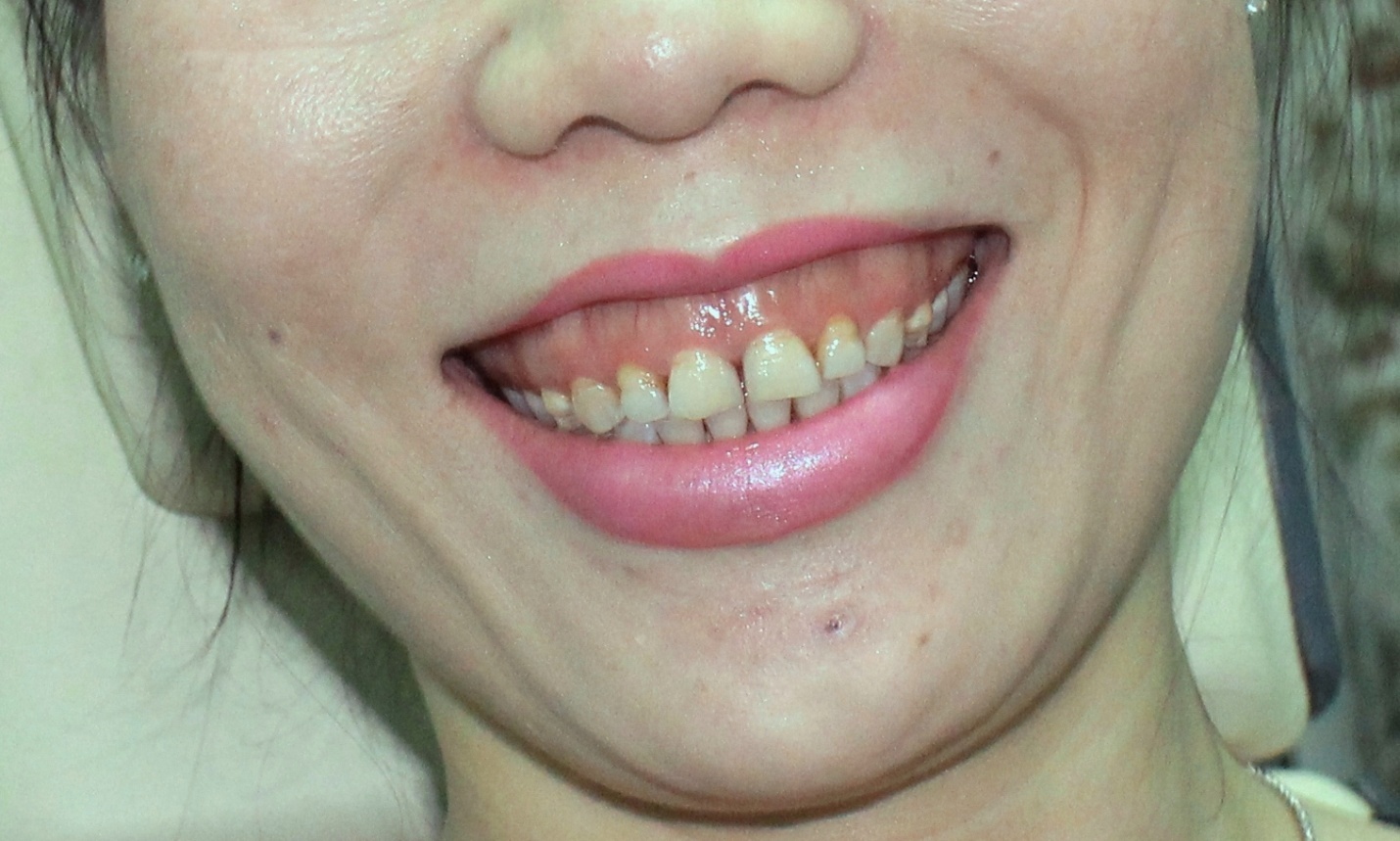 Trước điều trị.