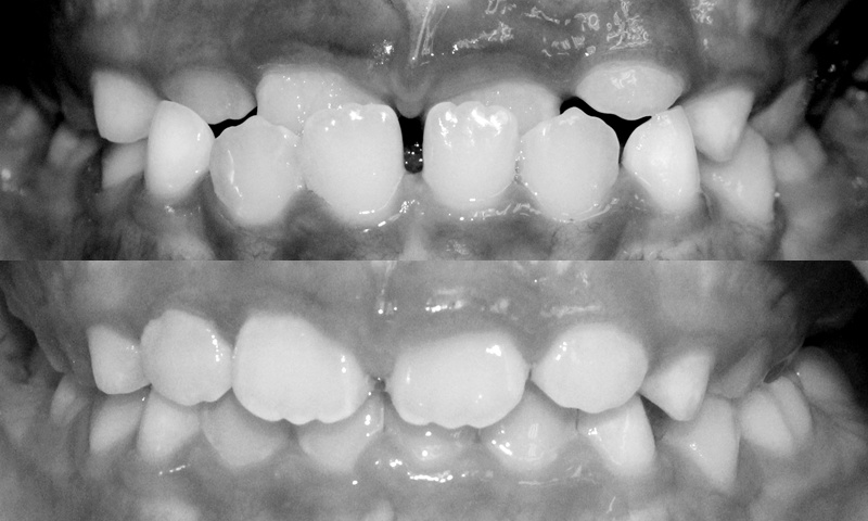 Bệnh nhân nữ 6 tuổi bị móm, điều trị can thiệp sớm với khí cụ trong 5 tuần.